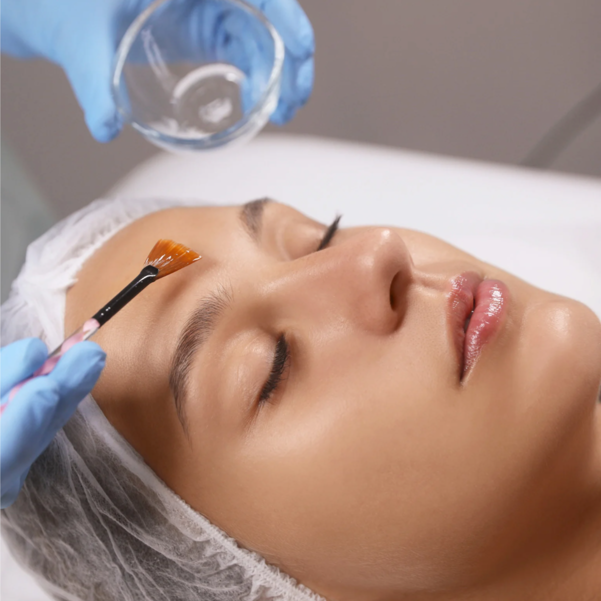 VI PEEL PRECISION PLUS at Ultimate Solutions Medical Spa in Stamford, CT