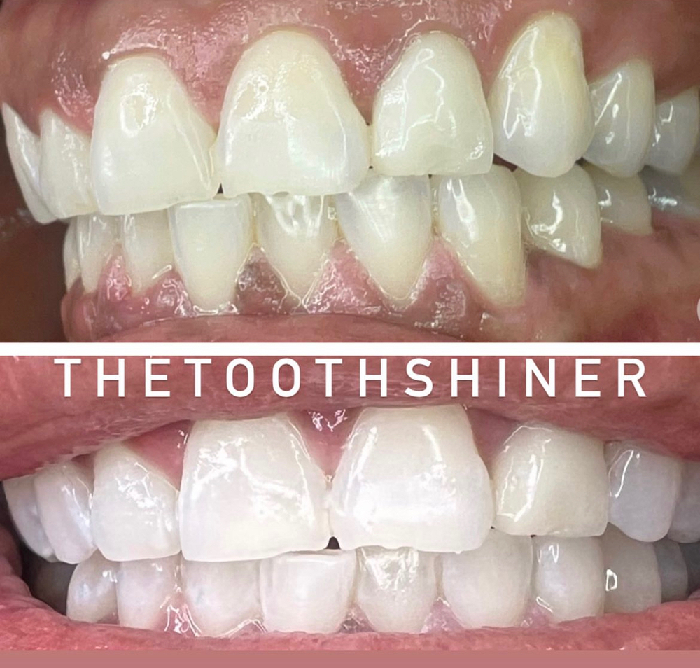 Pro Laser 30 Minute Teeth Whitening