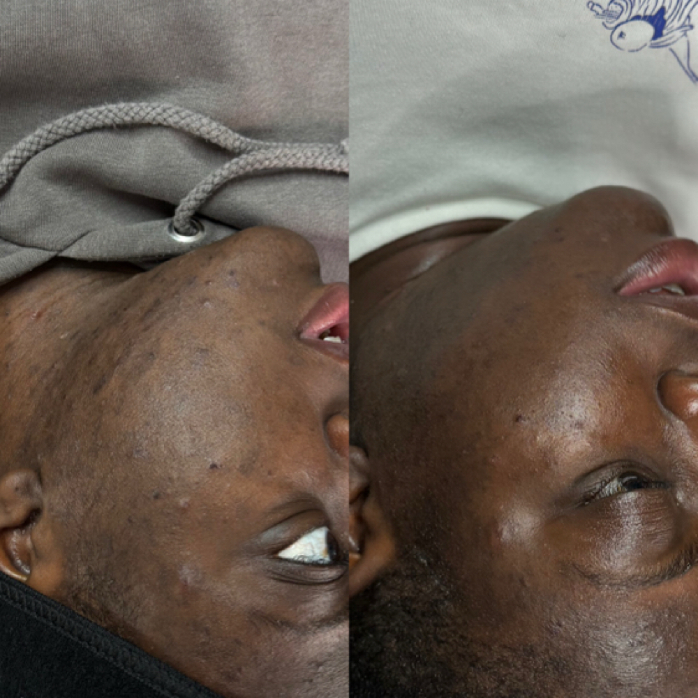 Acne Facial at GlamTwins  Studio in Brooklyn, NY