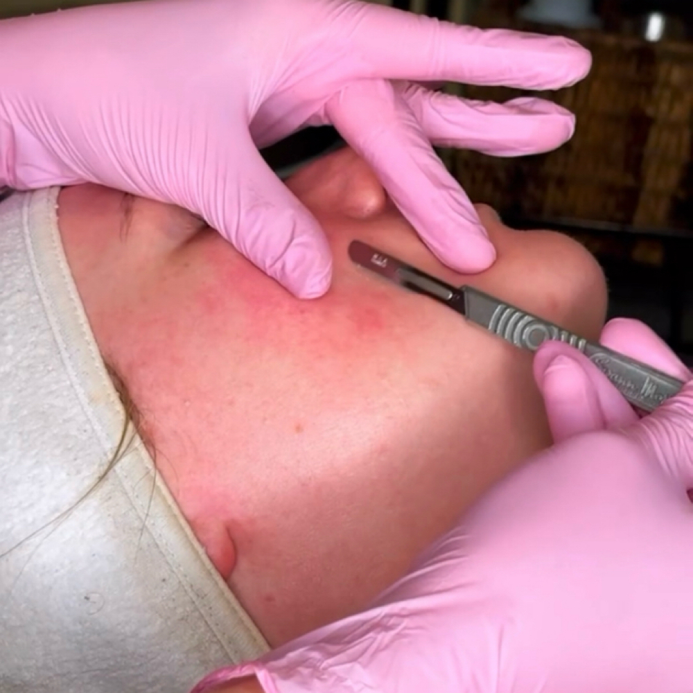Dermaplane Facial Basic at Healthy Skin Day Spa in Abilene, TX