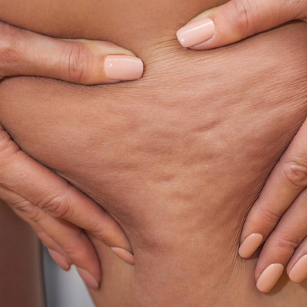 Cellulite Treatment at KB Esthetic Spa Inc. in Dalton, GA