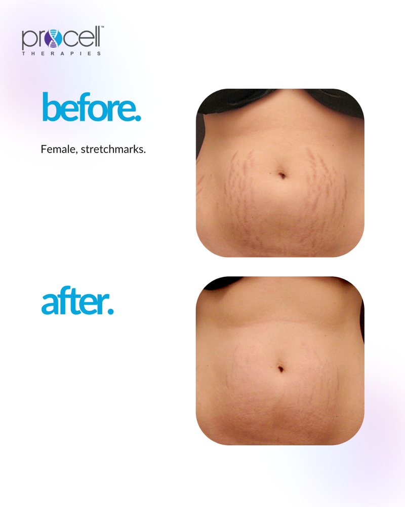 Scar Camouflage Tattoo at Angel Nails & Beauty Spa in Elk Grove, CA