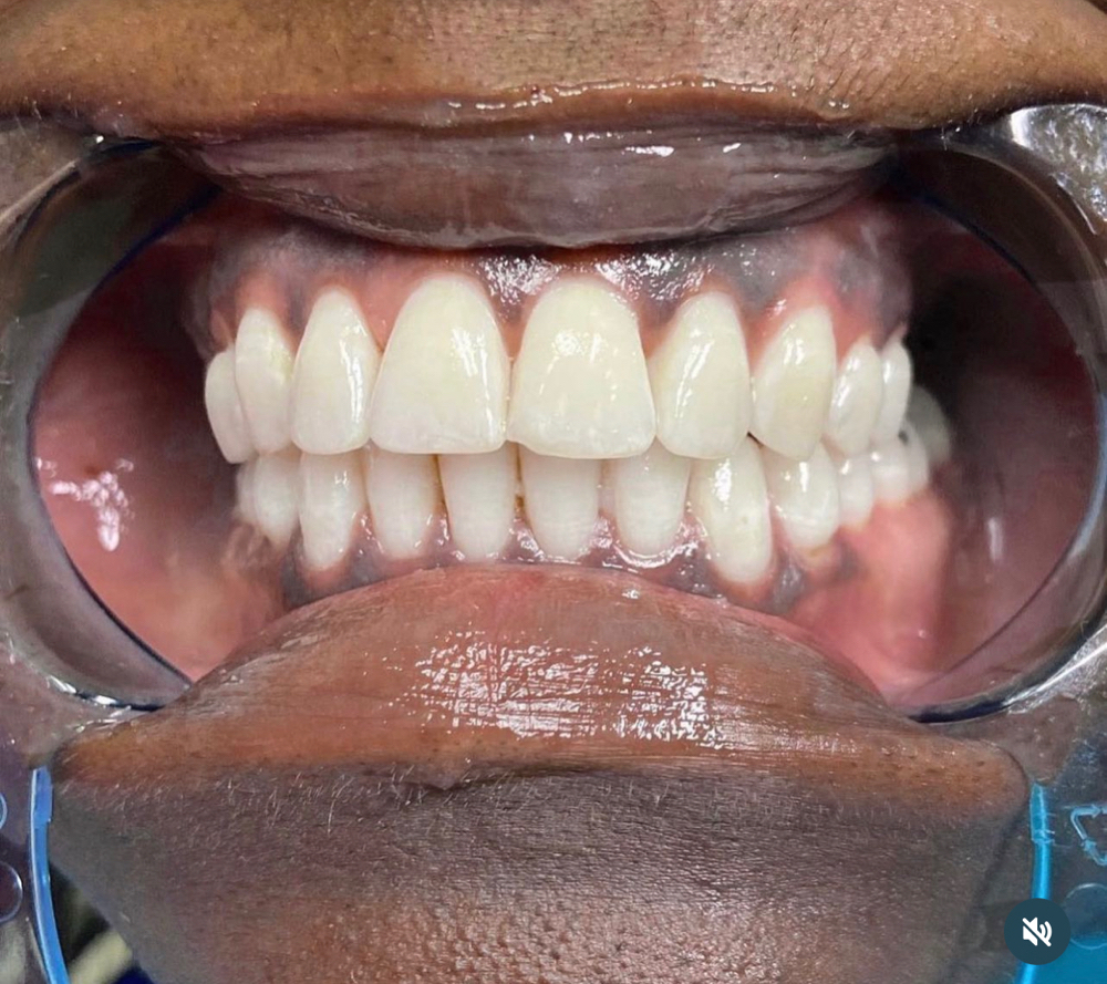60 Min Teeth Whitening Session