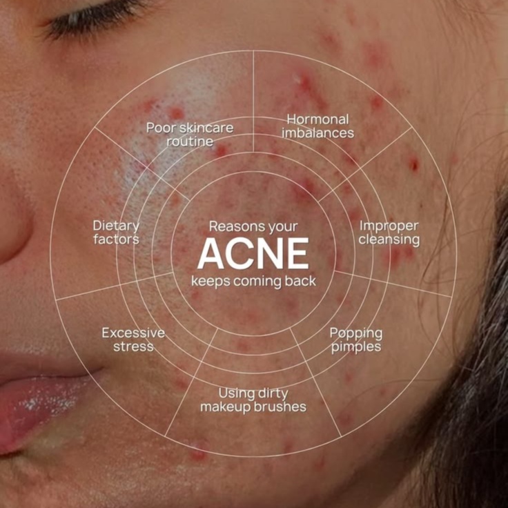 clarifying acne facial at shannyb_ esthetics in Fond du Lac, WI