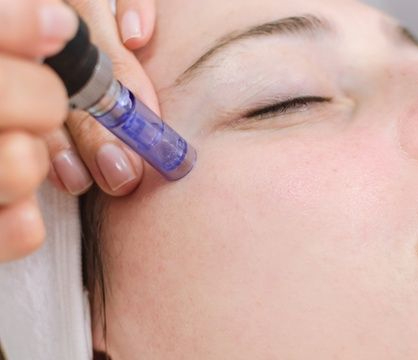 Microneedling Therapy