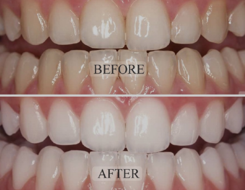 Teeth Whitening Follow-up