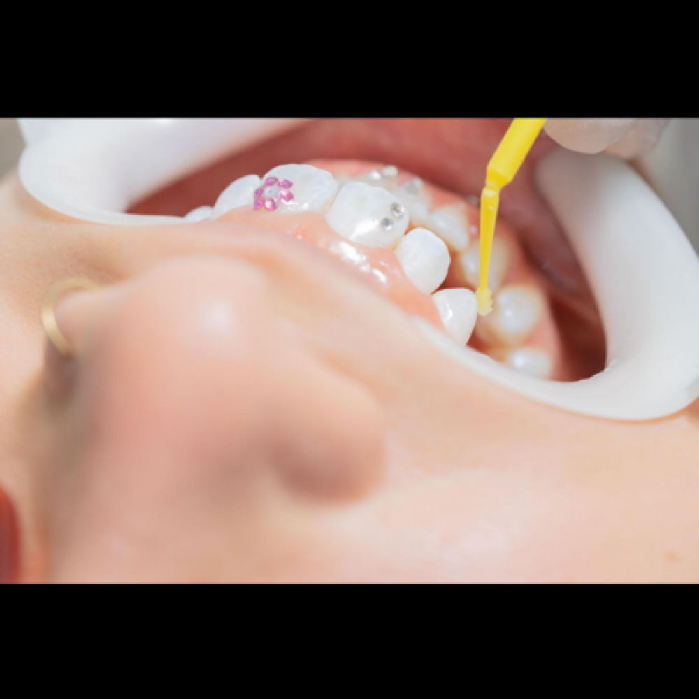 Tooth Gem Model (Contact To Book) at Icey Bodies in St Anthony, MN