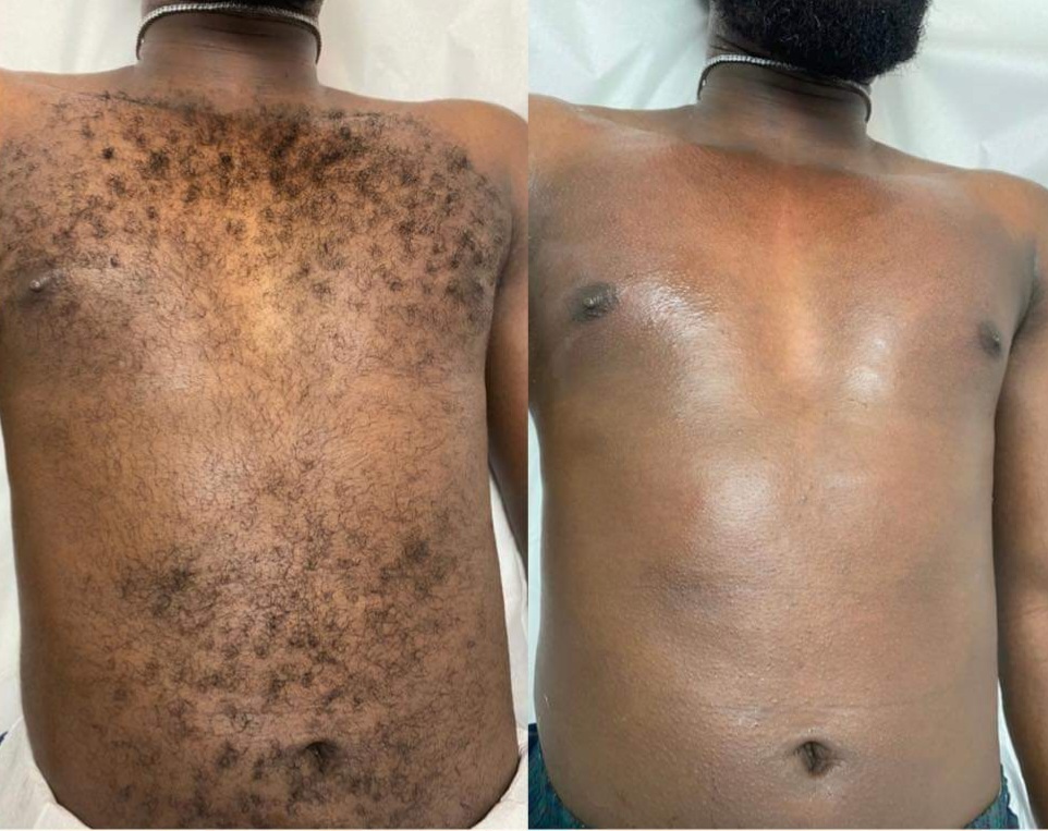 MALE CHEST WAX