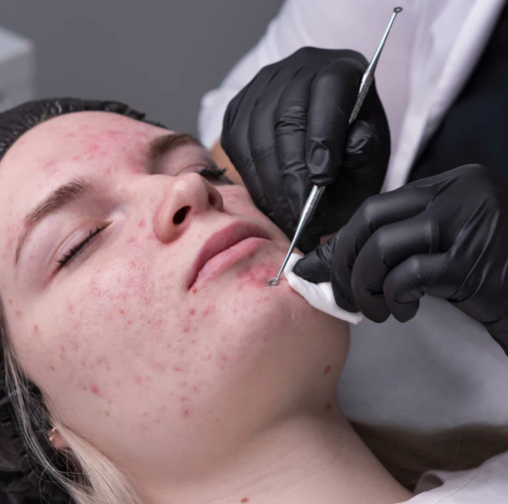 Acne Facial at Bare Skin Beauty in Springdale, AR