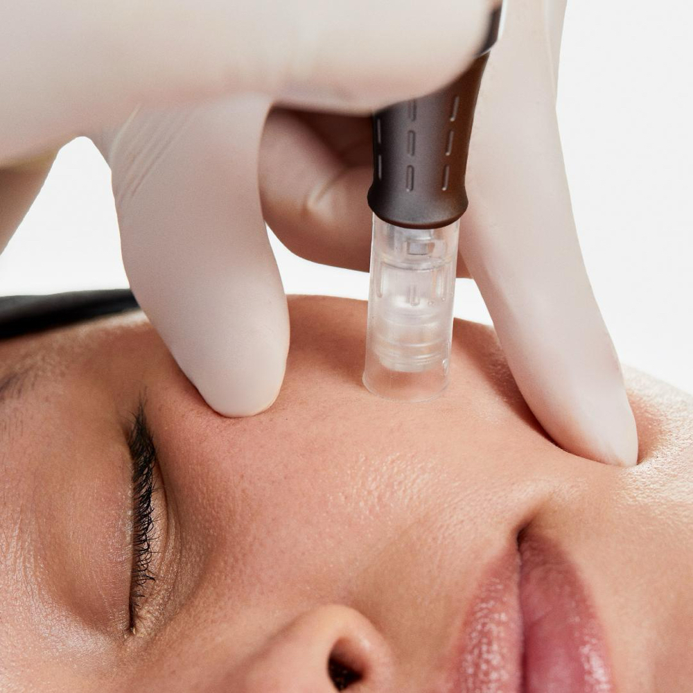 Microneedling Series at Brittney Murphy Skincare in Windsor, CO