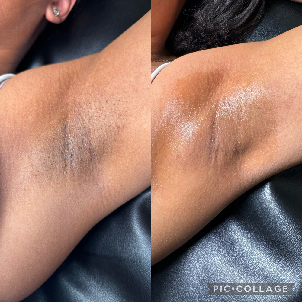Underarm Skin Lightening