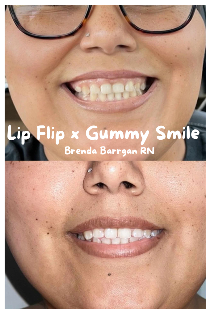Lip Flip ( Done With Tox ) at AllyouneedlexBB in Grand Praire, TX