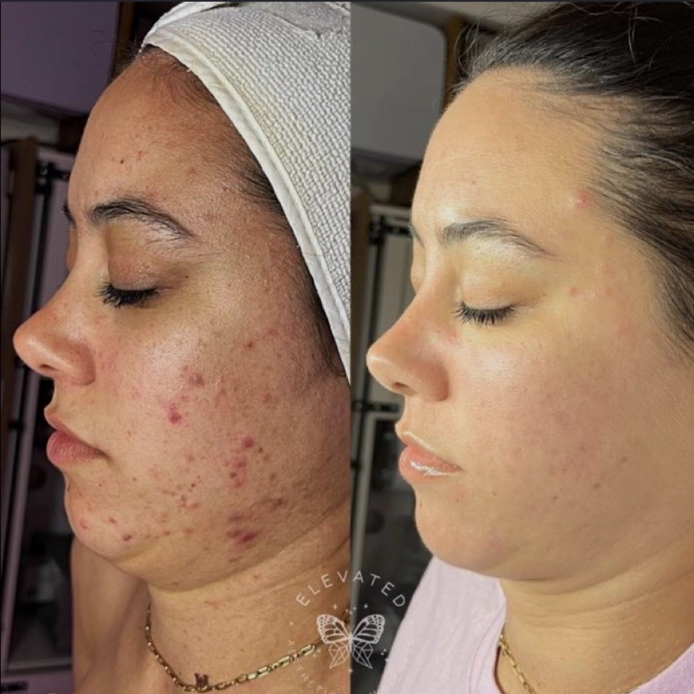 Chemical Peel (No downtime peel) at Rejuva Glow Beauty in Bethesda, MD