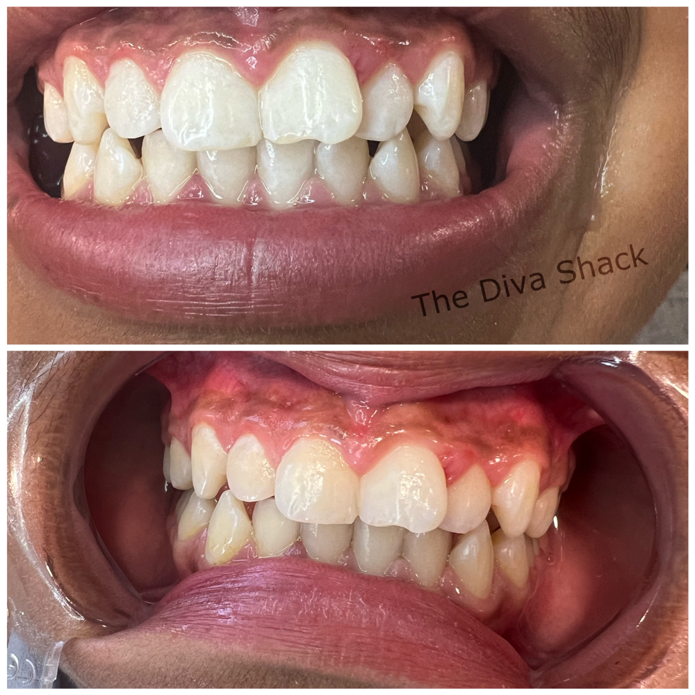 Teeth Whitening