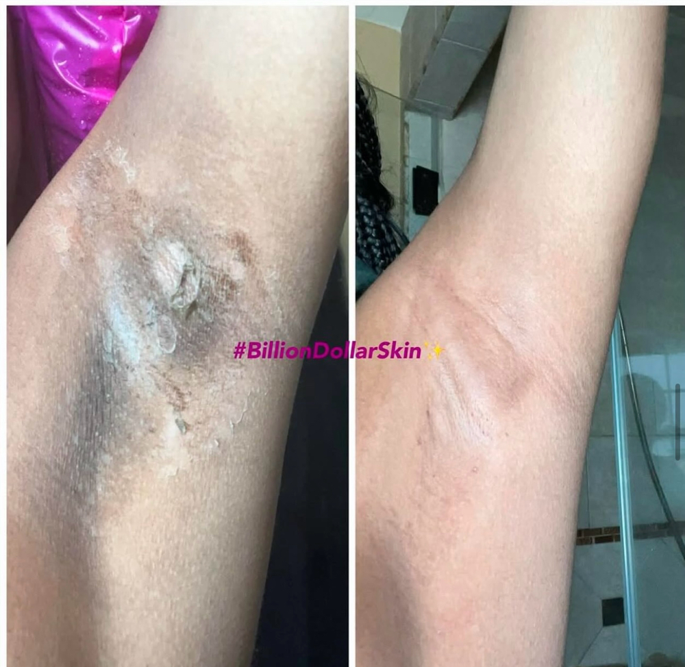 Underarm Intimate Bleaching