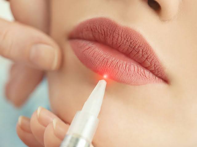 Lip Laser Rejuvenation