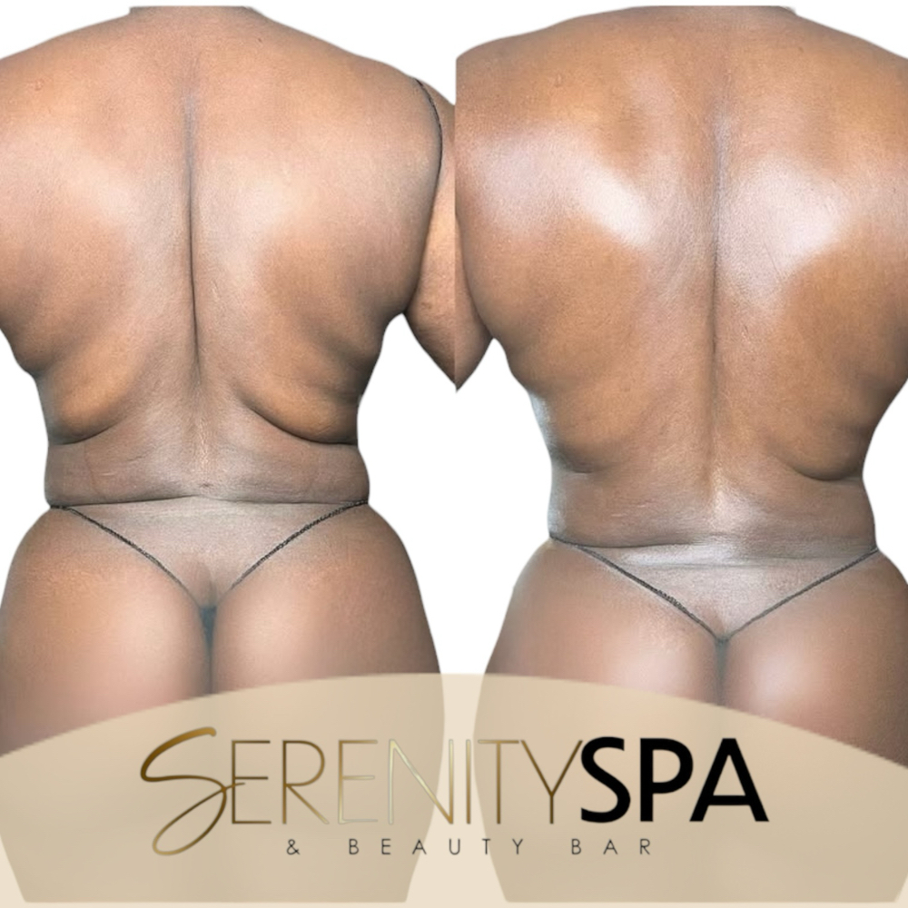 Post-Op Lymphatic Drainage Massage at Serenity Spa & Beauty Bar in Warwick, RI