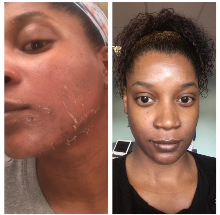 Deluxe Chemical Peel
