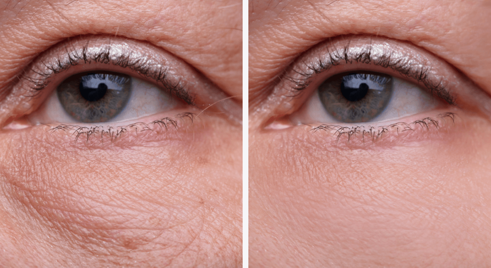 Under Eyes (Bags / Puffiness)