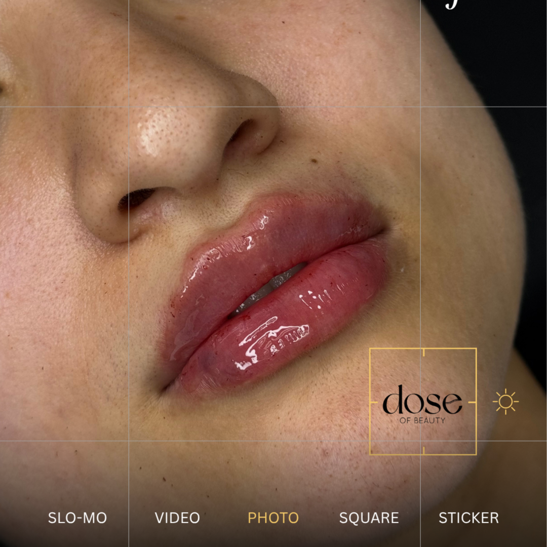 Lip Filler at DOSE OF BEAUTY in McAllen, TX