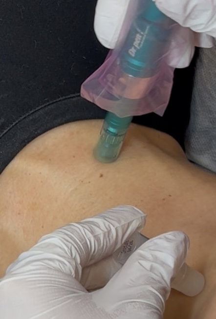 Neck-Microneedling W/ StemCells
