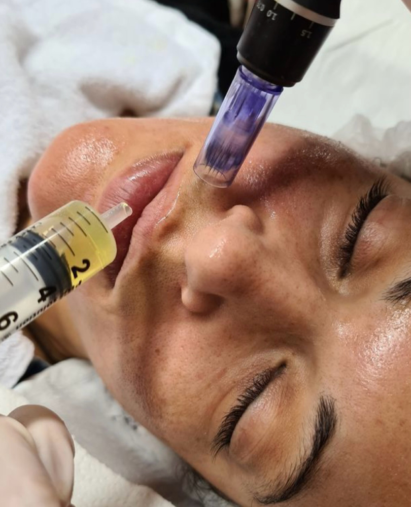 PRP Combine facial