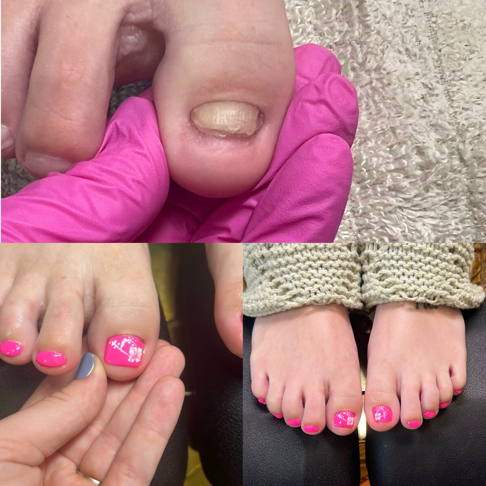 Toenail Reconstruction