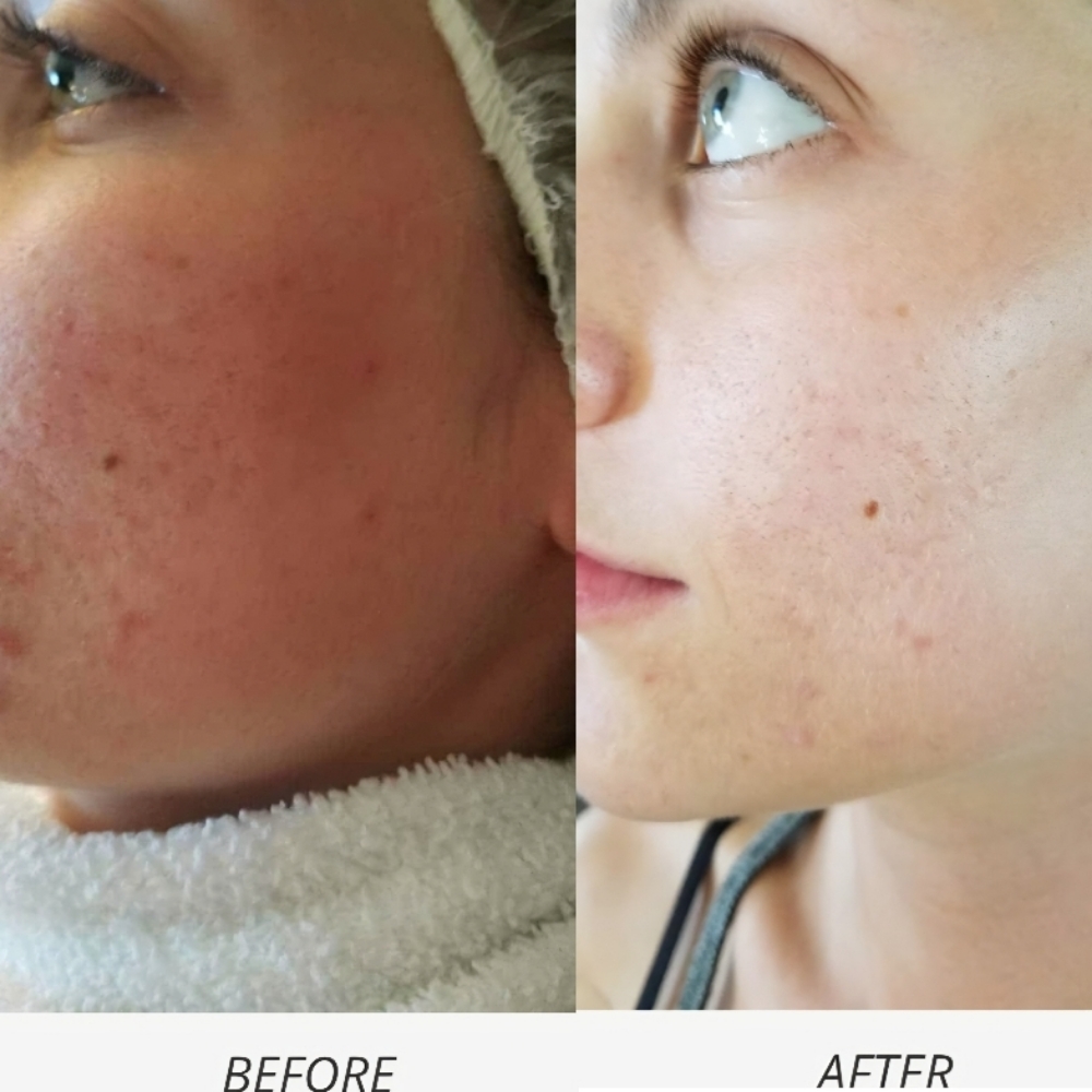 PowerDerm Dermabrasion