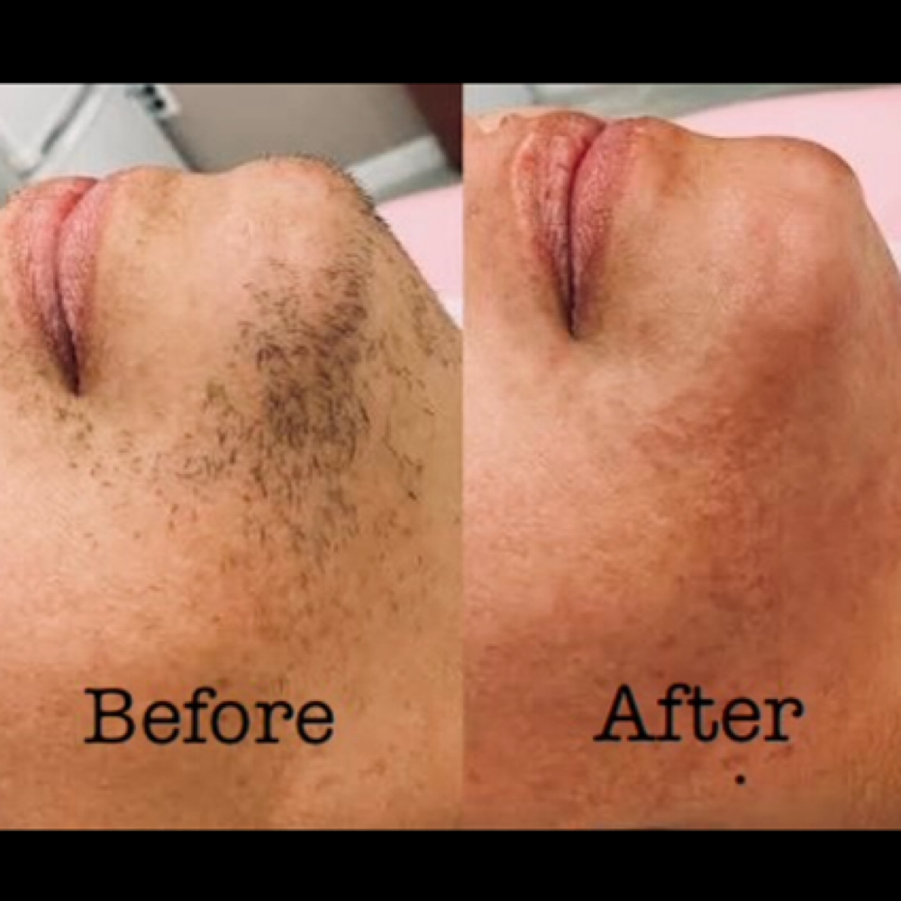 Chin/neck Wax at True Beauty Esthetics in Lufkin, TX