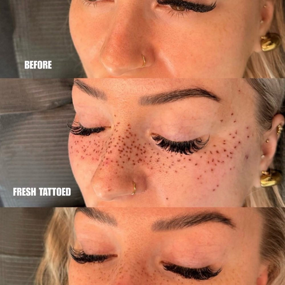 Cheeks and Forehead Freckle Tattoo at Amethyst Spa in Omaha, NE