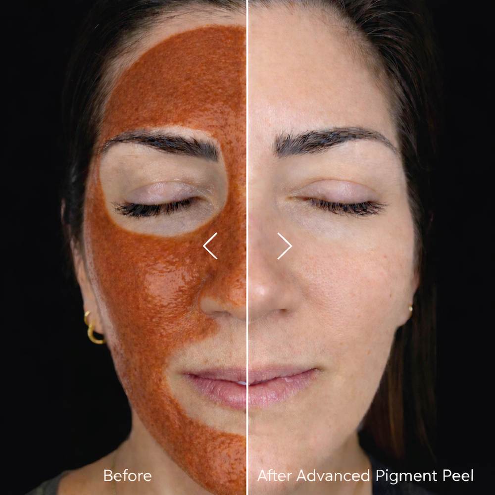 Advanced Pigment Correction Peel at Principled Skin Aesthetics by Annie Reay in Frisco, TX