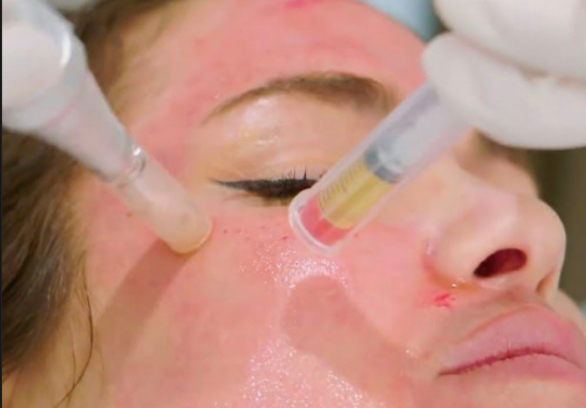 PRP/PRF RNR MicroNeedling Add On.