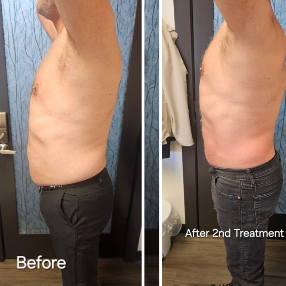 Cryotherapy Slimming & Toning at Tranquil Beauty LLC in South Jordan, UT