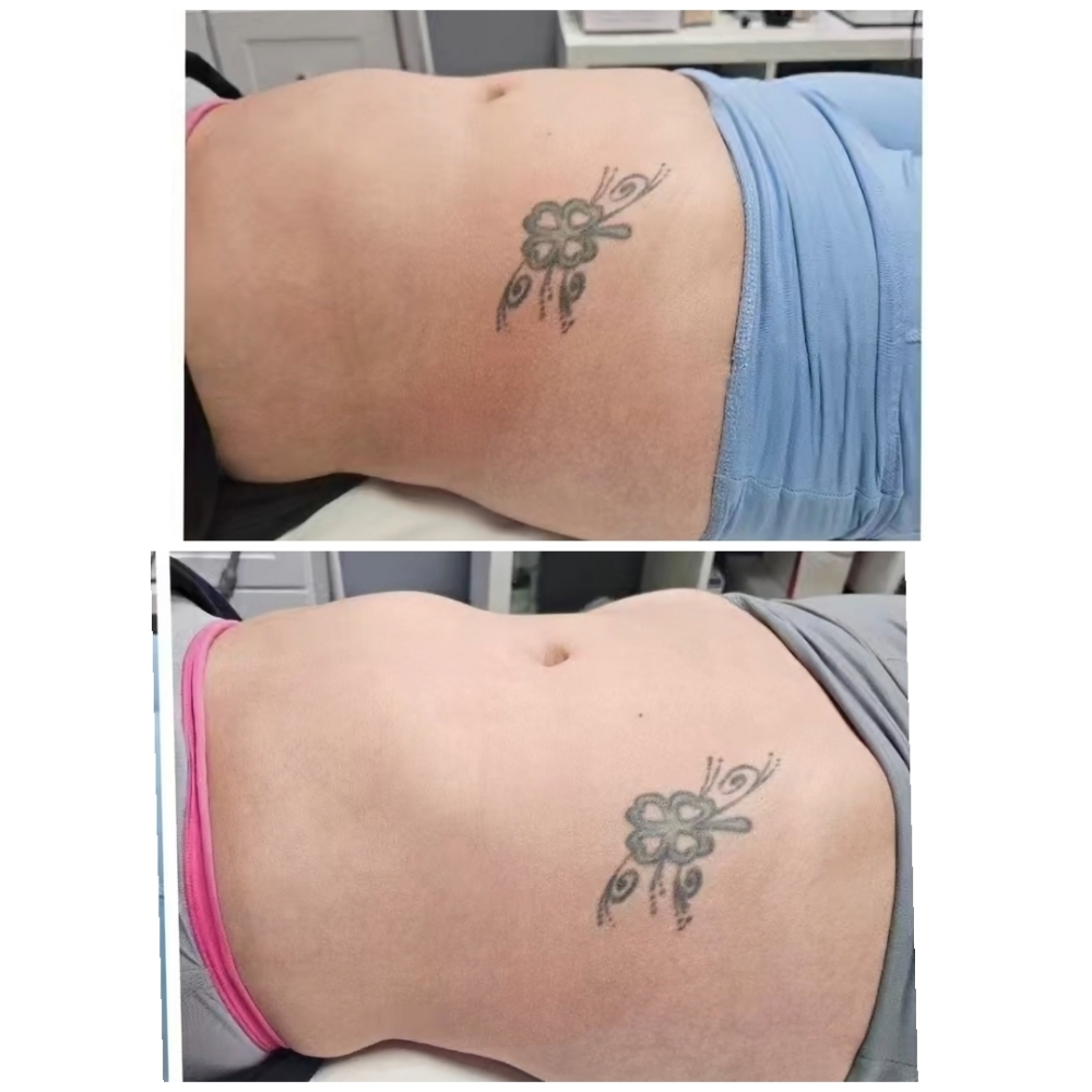 Cryotherapy Slimming & Toning