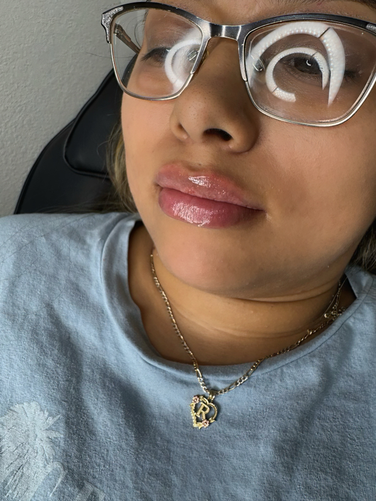 Bestie Special 0.5ml Filler at Palméra Aesthetics in Killeen, TX