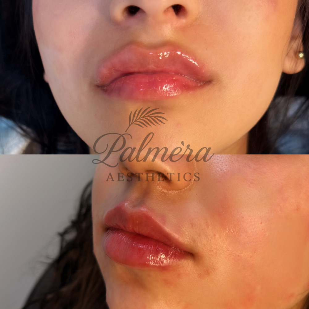 Bestie Special Lip Filler at Palméra Aesthetics in Killeen, TX
