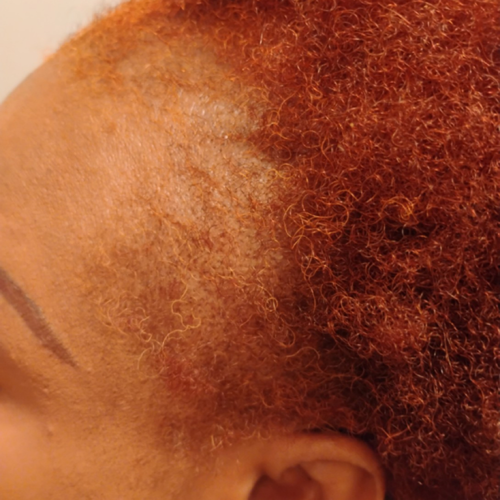 Stimulating Scalp Therapy at SLS HAIR & SCALP WELLNESS in Brooklyn, NY