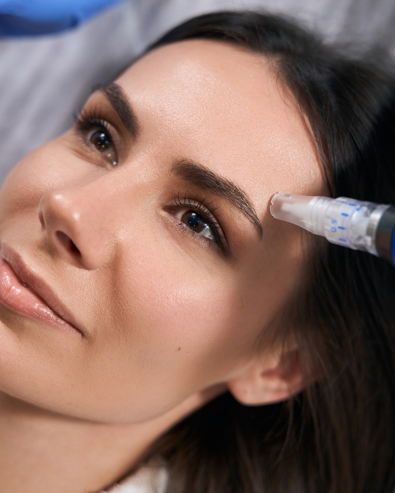 MicroNeedling