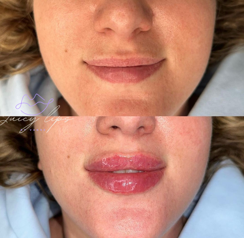 Lip Filler  1 ML Without Needle at Dfwbrowsbyvannemorales.com in Fort Worth, TX
