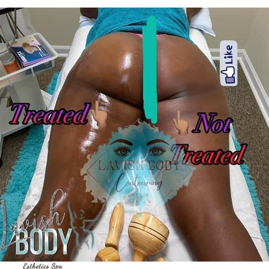6 Butt Enhancement 6 Sessions