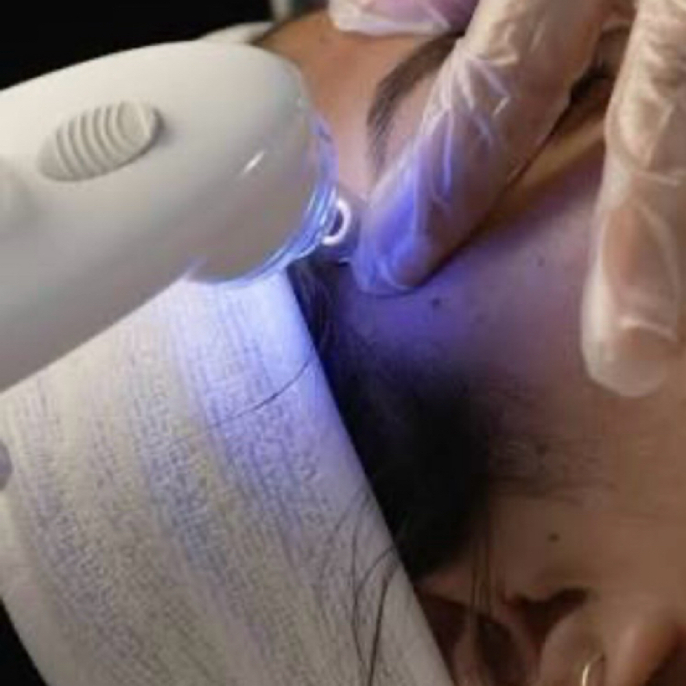Hydro-Dermabrasion at Simple Skin With Madison in Omaha, NE