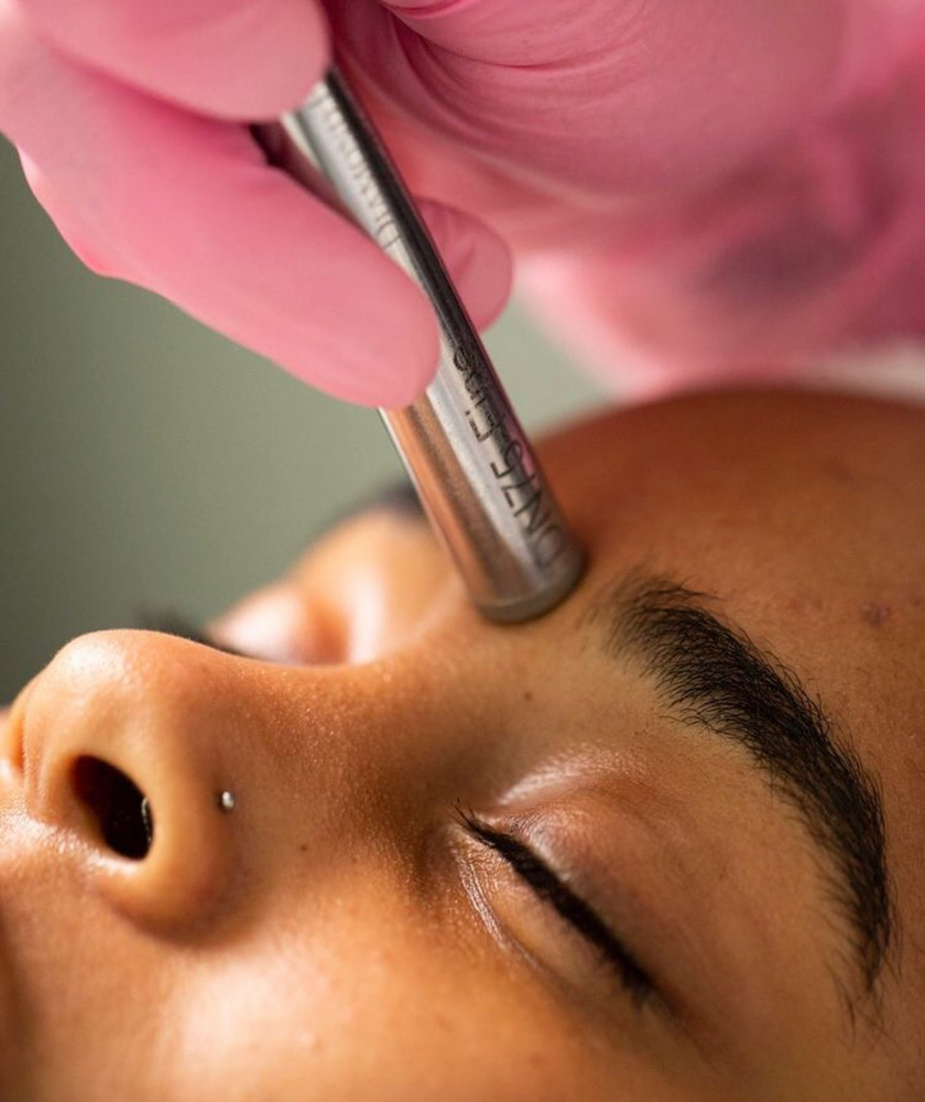 Microdermabrasion