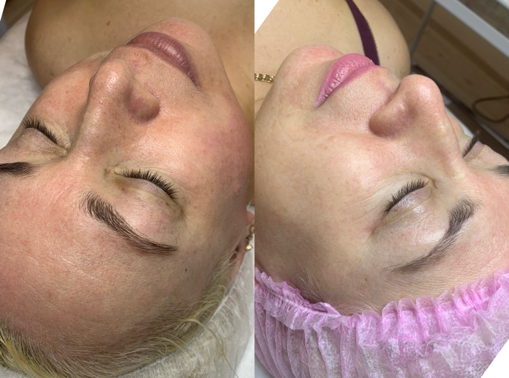 Renewal Peel at Healthy skin by Alvina in Highland Park, IL