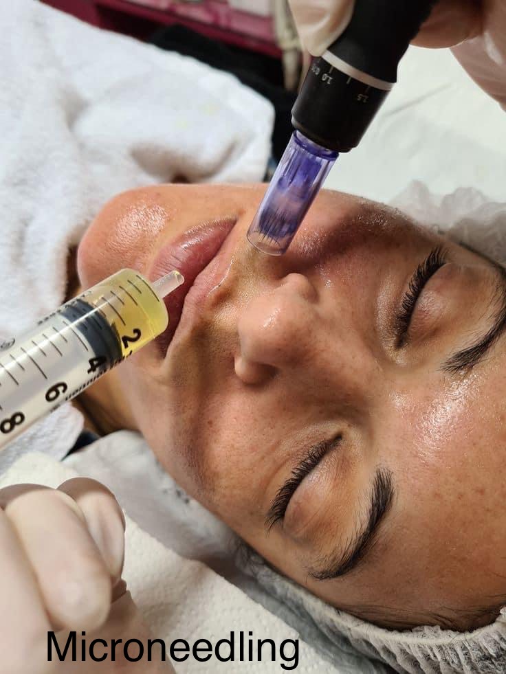 Microneedling Facial