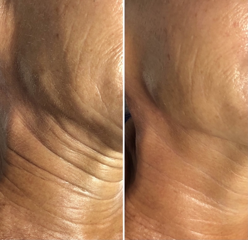 Skin Tightening - Microcurrent :