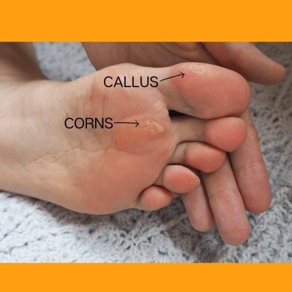 FISSURES/ CALLUSES/ CORNS