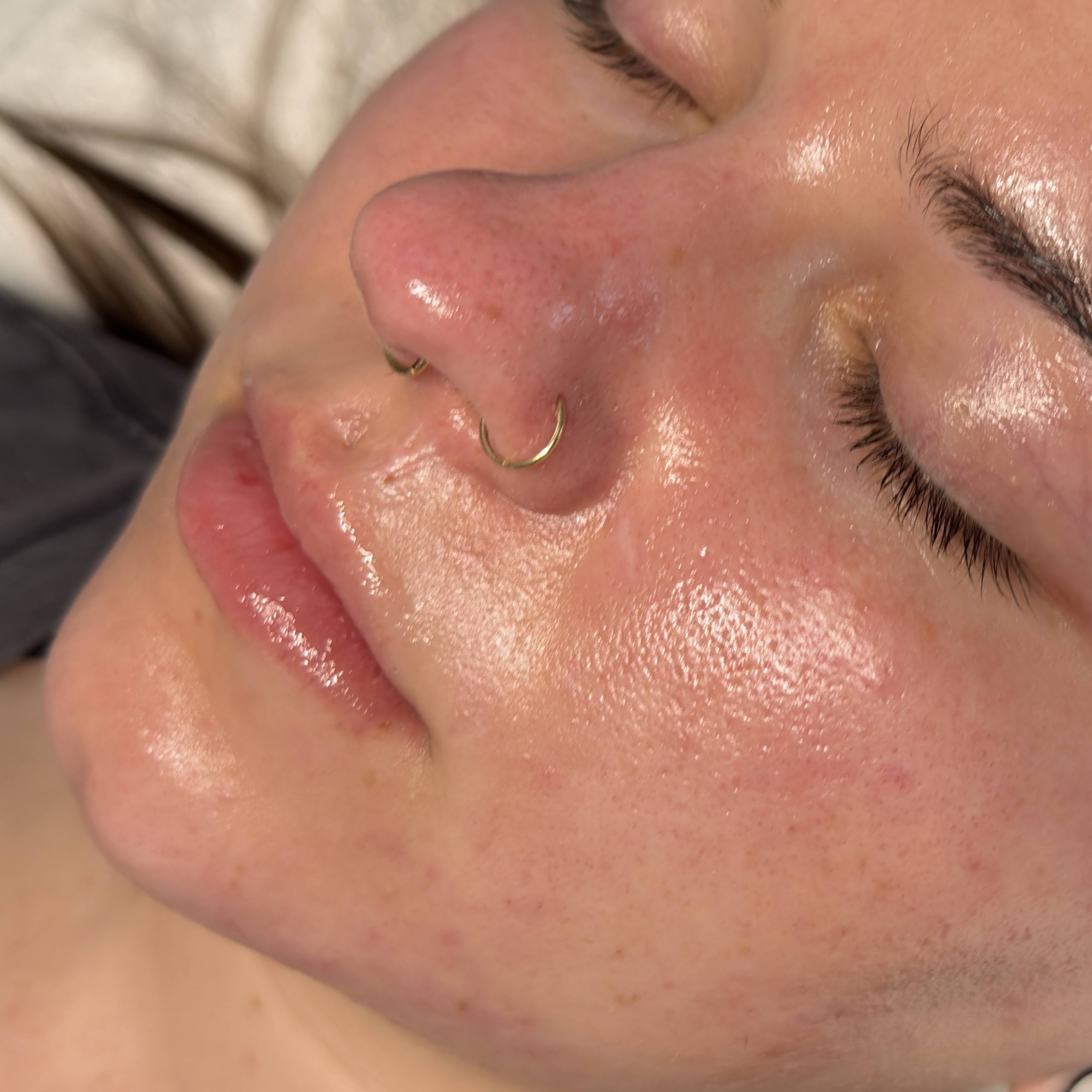 Nano Infusion Treatments at Bio Skin Aesthetics in Boise, ID