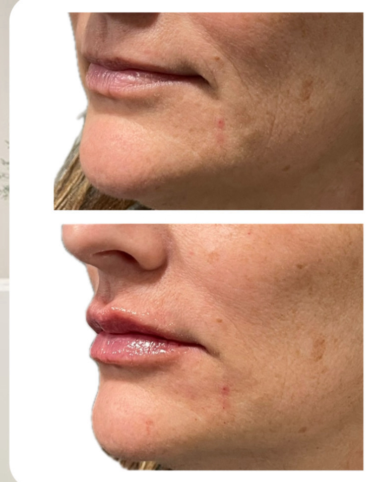 Dermal Filler - Lips