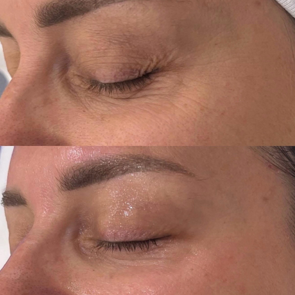 Hydrafacial Eye Perk Add On at Anfissa Beauty in Mount Angel, OR