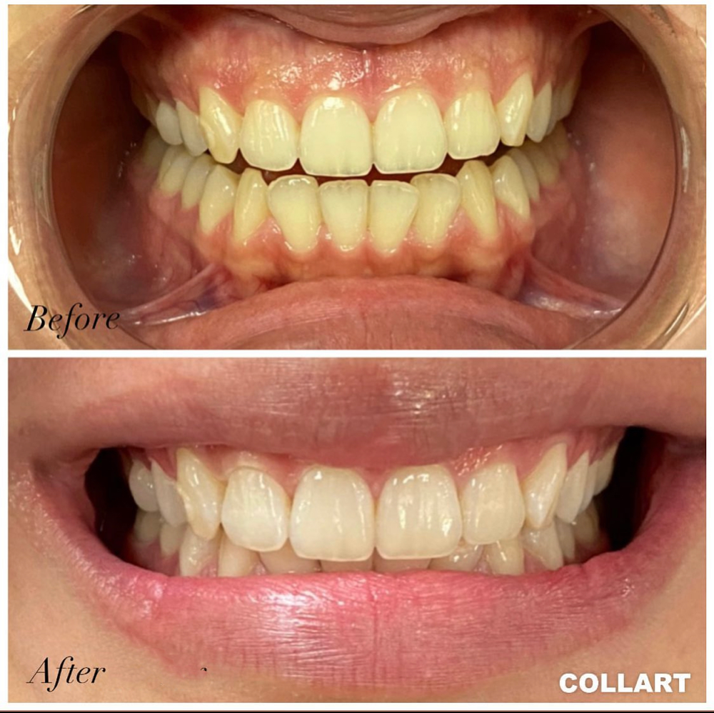 30 Min Teeth Whitening